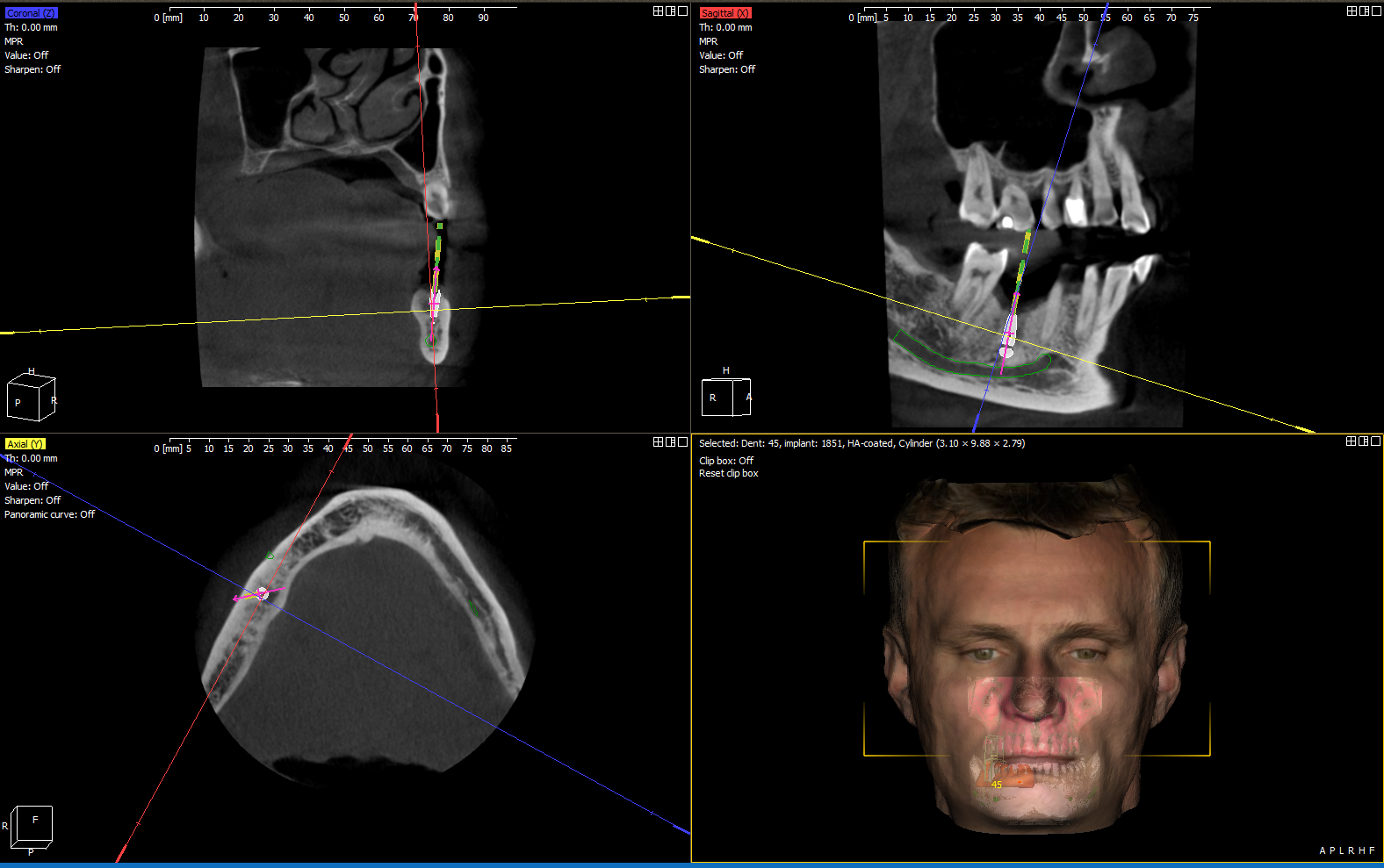 CBCT scan